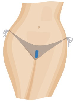 A diagram showing the areas of hair removed for a Brazilian wax